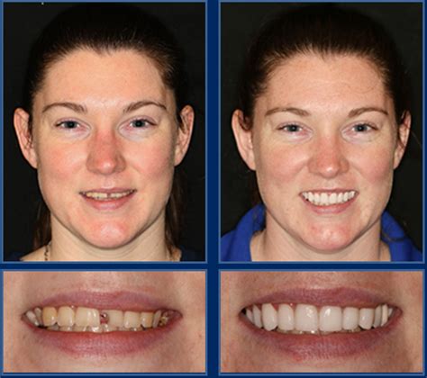 are cheap dental implants any good